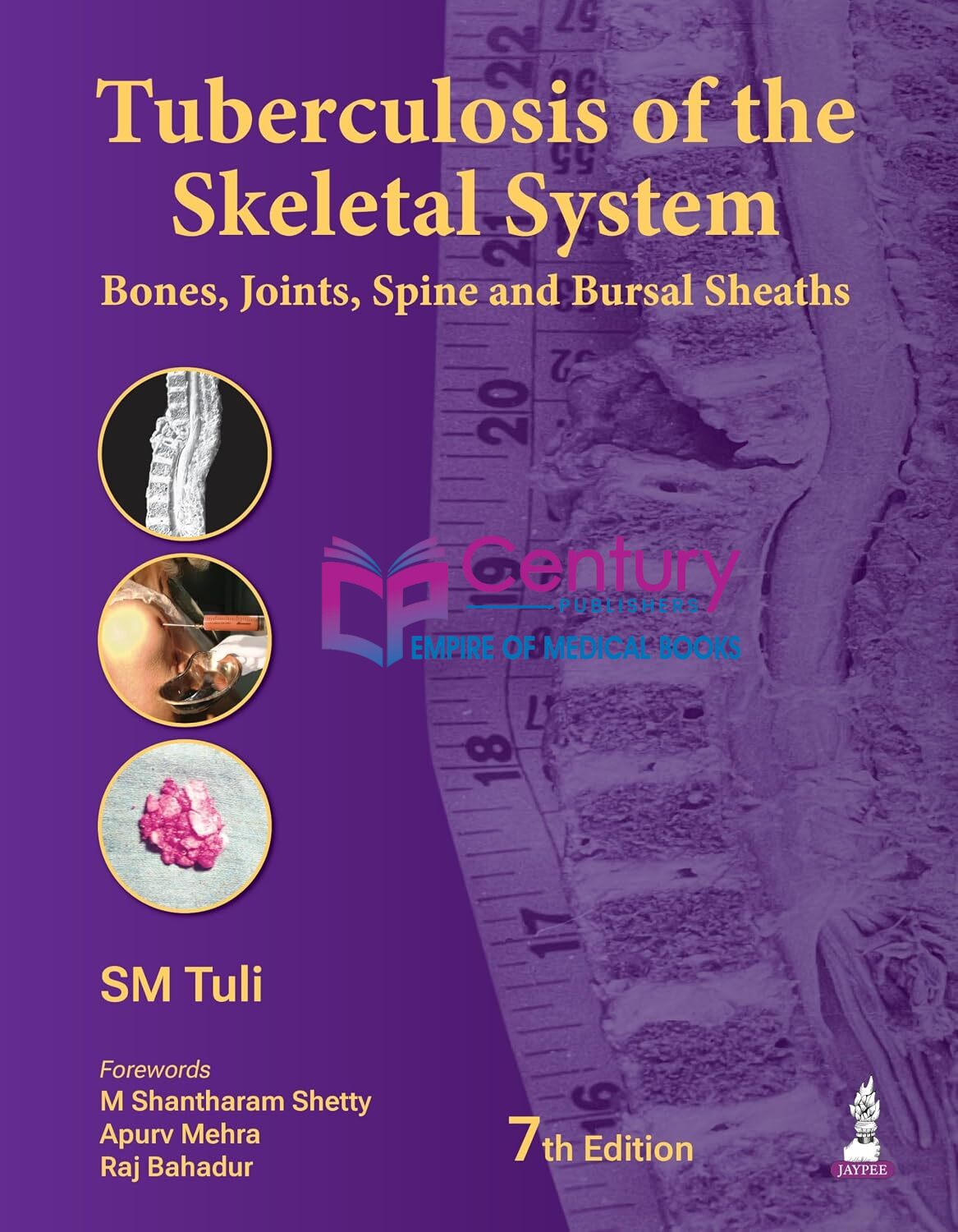 Tuberculosis-of-the-Skeletal-System-Bones-Joints-Spine-and-Bursal-Sheaths-7th-Edition-by-S-M-Tuli-bGRUH